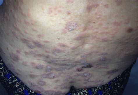 Erythematous Scaly Plaques Clinical Aspect Of Psoriasis Vulgaris