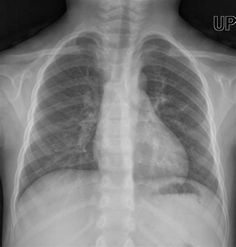 Serial Chest Radiographs A Preoperative Normal Chest Radiograph B
