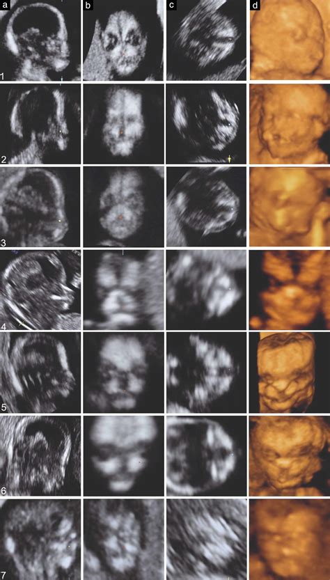 First‐trimester Diagnosis Of Cleft Lip And Palate Using Three