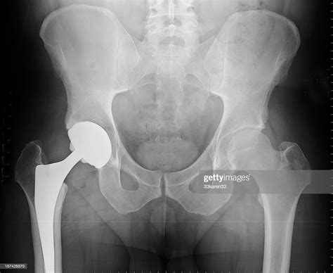 Xray Of Total Hip Arthroplasty High Res Stock Photo Getty Images