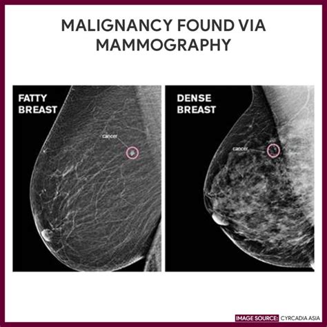 Mammography Mammogram Nursing Responsibilities Nurseslabs