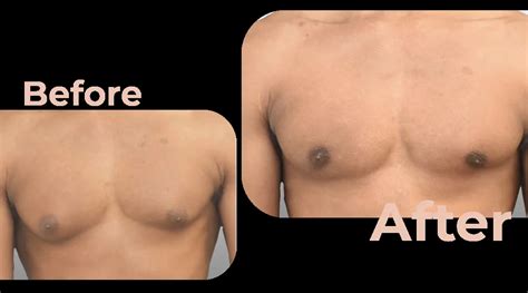 Male Breast Reduction Surgery Before And After Photos Avicenna Hospital