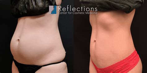 Laser Lipo For Slim Toned Abs Love Handles Before After Photos