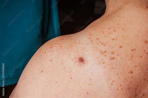 Age Spots Moles And Freckles On The Shoulders And Back Of An Older