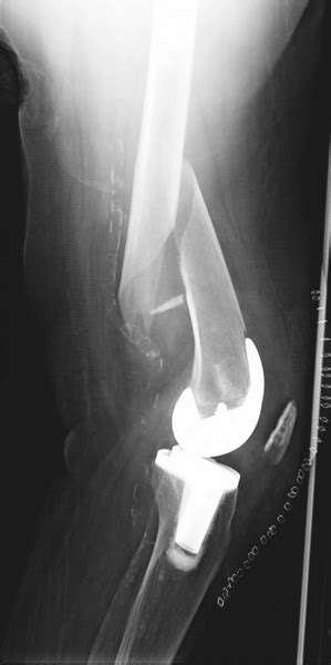 Periprosthetic Fractures Associated With Total Knee Arthroplasty Bone