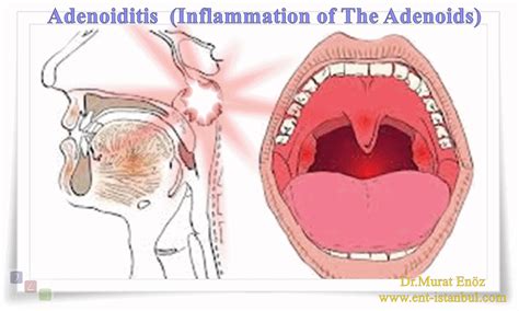 Adenoiditis Symptoms Causes Diagnosis And Treatment