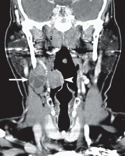 Head And Neck Squamous Cell Cancer With Nodal Metastases Radiology Key