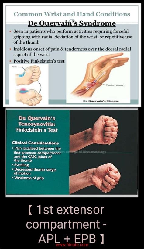 De Quervain Syndrome Finkelstein Test Hand Therapy Yoga Therapy
