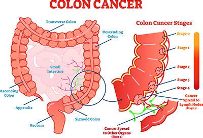 I know the standard answer would be something like it depends and everyone is different, but maybe you have discussed this with your doctors and have some insights for me? What are the side effects of colon cancer? : Augusta Free ...