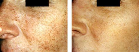 Laser Skin Treatment Lakeshore Vein And Aesthetics Clinic Pre And Post