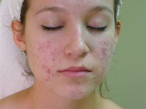 9 Face Mapping Acne Spots And What Every Acne Spot Means