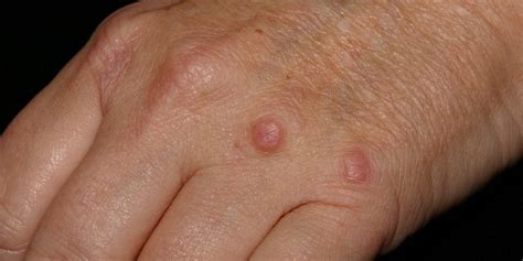 What Do You Know About Granulomas Safar Medical