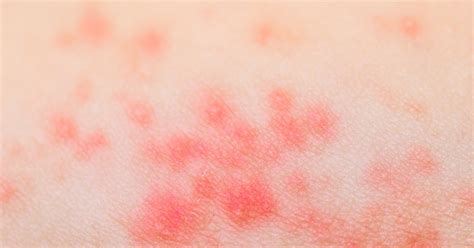 Pictures Of Skin Rashes Different Type Of Skin Rashes Healthy