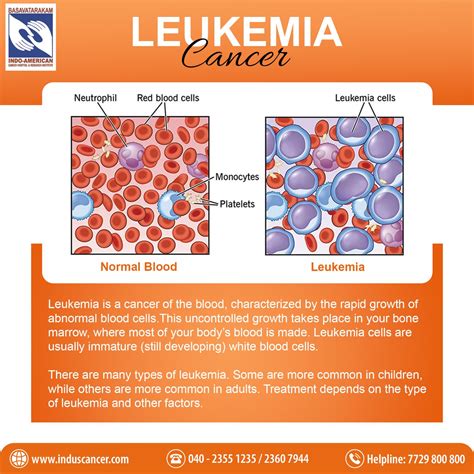 Leukemia Types And Prognosis