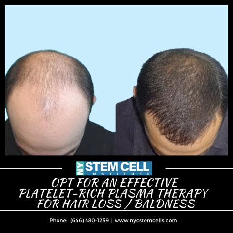 Platelet Rich Plasma Therapy For Hair Loss Platelet Rich Plasma