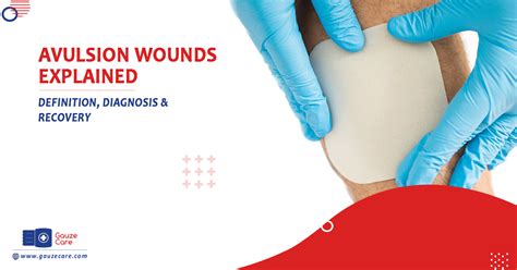 Quick Guide To Avulsion Wounds Diagnosis And Recovery