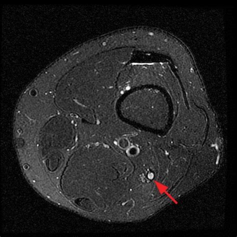 Superficial Peroneal Nerve Mri