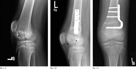 Figure 1 From Distal Femoral Extension Osteotomy And Patellar Tendon