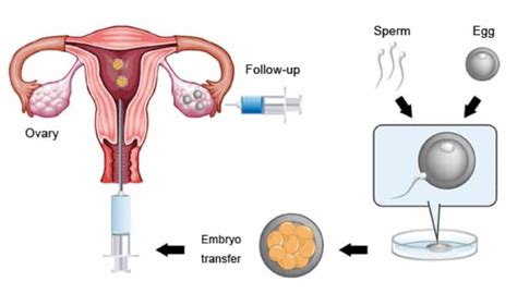 Embryo Transfer Nurture Fertility Centre And Womens Specialty Clinic