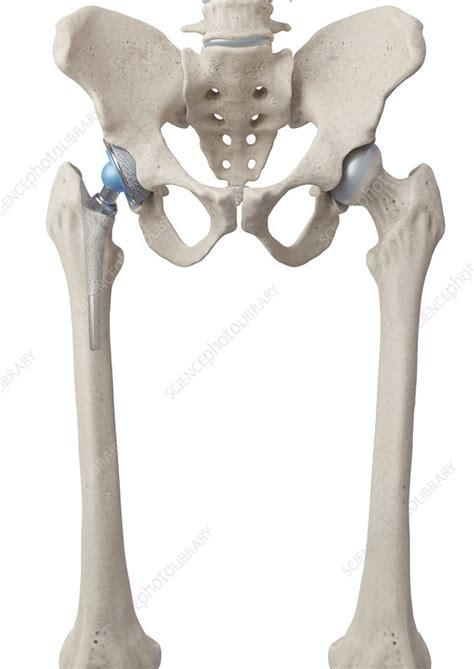 Hip Replacement Artwork Stock Image C052 3629 Science Photo Library