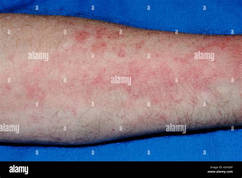 Skin Rash Of Eczema On The Forearms Of A 55 Year Old Man Stock Photo