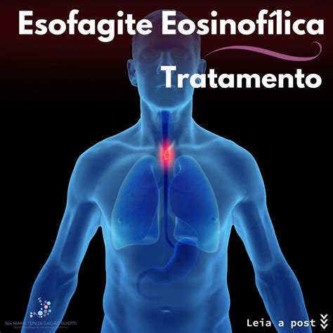Tratamento Esofagite Eosinof Lica Dra Maria Tereza Pediatra