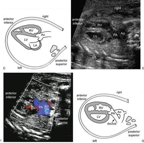Figure 14 8 Left And Right Ventricular Outflow Tract Views A