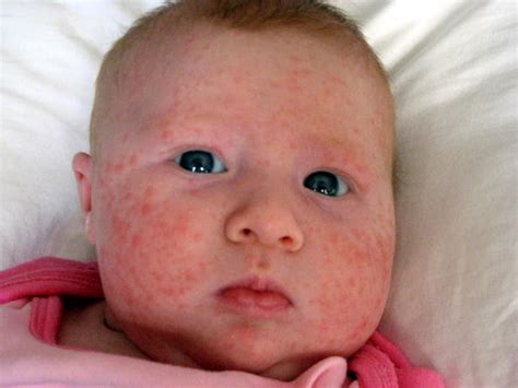Baby Pimples Baby Acne Causes And How To Get Rid These Problems