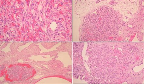 Pathology Findings Pancreatic Kaposiform Hemangioendothelioma