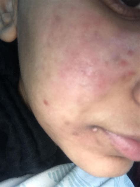 Routine Help Itchy Dry And Red Face With Blind Pimples R