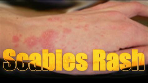 Contagious Itchy Bumps On Skin Toxoplasmosis