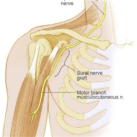 Transfer Of The Third And Fourth Intercostal Motor Nerves To The