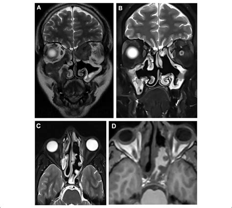 Magnetic Resonance Images Mris Of The Paranasal Sinus A With A