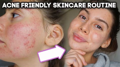 My Acne Skincare Routine Evening Routine Simple Skincare Youtube