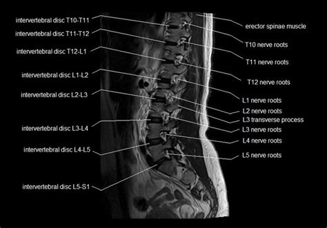 The Joint Between The L2 And L3 Vertebrae Is A