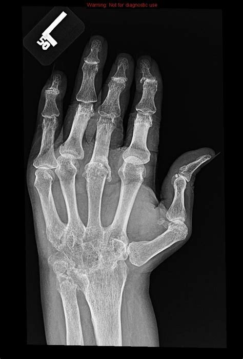 Rheumatoid Arthritis X Ray Rebecca Bond