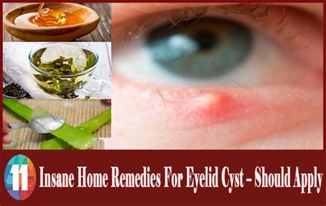 11 Insane Home Remedies For Eyelid Cyst Should Apply