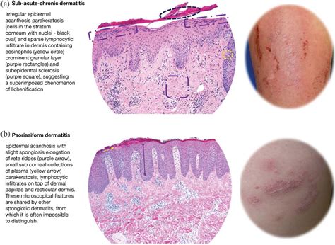 Nomenclature And Clinical Phenotypes Of Atopic Dermatitis Giampiero Girolomoni Marjolein De