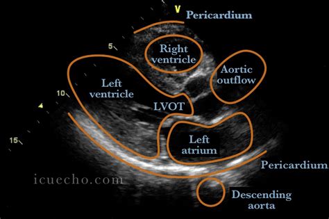 Parasternal Long Axis Icu And Echo