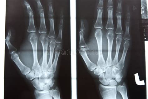 Human Left Hand Xray Image Stock Image Image Of White 11967655