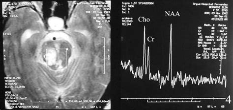 Expanding Virchow Robin Spaces In The Midbrain Causing Hydrocephalus