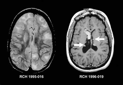 Brain Mri With Contrast Showing Ms Images Mri Scan Mri Scan