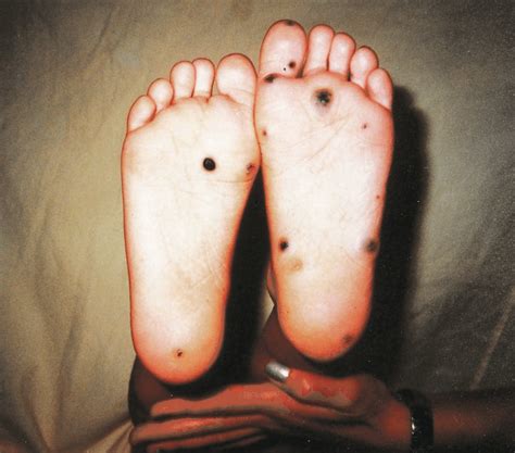 Multiple Bluish Black Lesions On The Soles Of The Feet Of The Patient Download Scientific Diagram