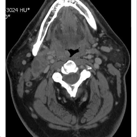 Axial Cut Ct Of Right Oropharyngeal Neoplasm With Right Submandibular
