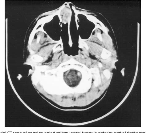 Figure 1 From Nasal Septal Tumor As A Sole Presentation In The Head And