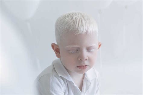 Albinismus Geht Mit Einer Verminderung Des Farbstoffs