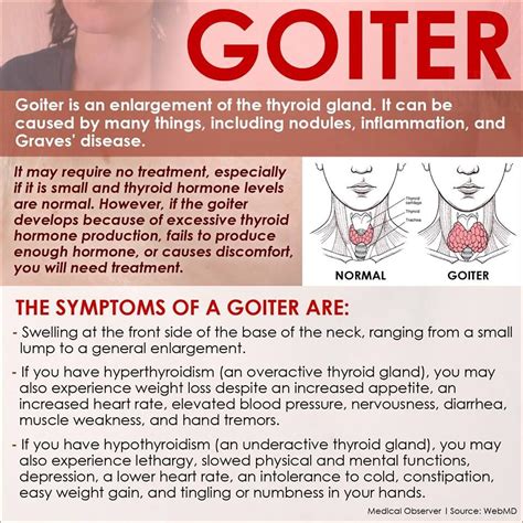 Goiter Thyroid Treatment Thyroid Goiter Thyroid