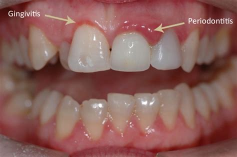 Gum Disease Christopher Sale Dentistry