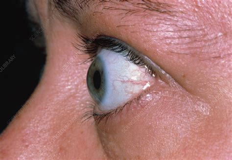 Bulging Eye Of Person With Thyrotoxicosis Stock Image M2700138