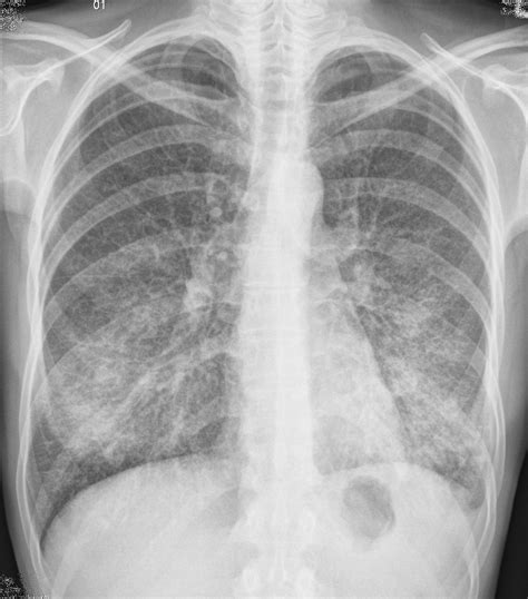 The ai system correctly classified chest radiographs as demonstrating. Atypical Pneumonia. Causes, symptoms, treatment Atypical ...